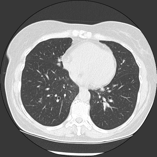 Amyloidosis - bronchial and diffuse nodular pulmonary involvement (Radiopaedia 60156-67744 B 38).jpg