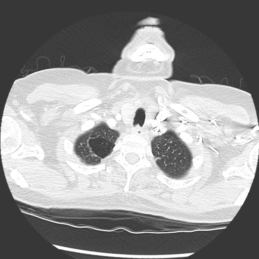 Amyloidosis - bronchial and diffuse nodular pulmonary involvement (Radiopaedia 60156-67745 Axial lung window 4).jpg