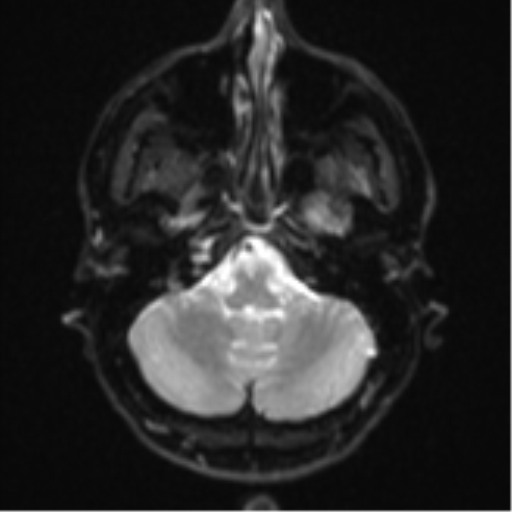 File:Anaplastic astrocytoma (Radiopaedia 57768-64731 Axial DWI 5).png