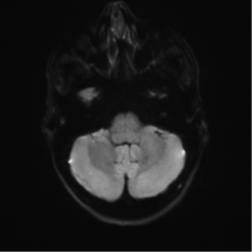 Anaplastic astrocytoma IDH mutant (Radiopaedia 50046-55341 Axial DWI 33).png