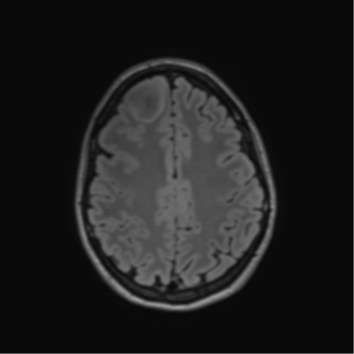 File:Anaplastic astrocytoma IDH mutant (Radiopaedia 50046-55341 Axial FLAIR 36).png