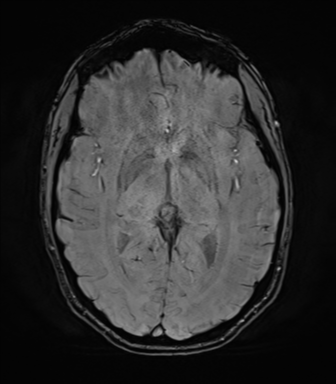 File:Anaplastic astrocytoma IDH mutant (Radiopaedia 50046-55341 Axial SWI 43).png
