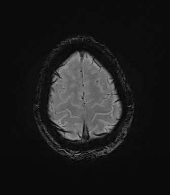 File:Anaplastic astrocytoma IDH mutant (Radiopaedia 50046-55341 Axial SWI 77).png
