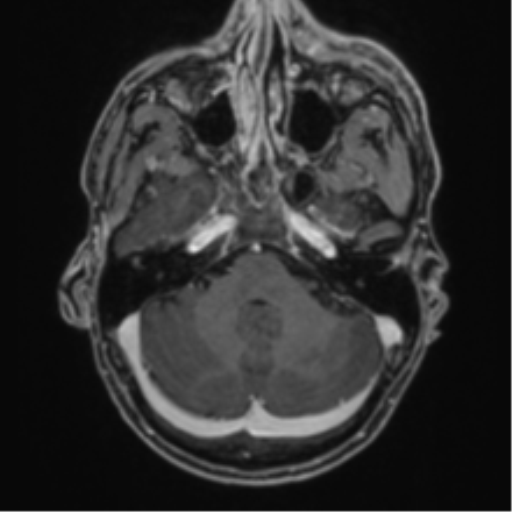 Anaplastic oligodendroglioma with skull fracture (Radiopaedia 74831-85845 Axial T1 C+ fat sat 11).png