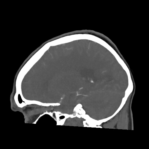 Aneursym related subarachnoid hemorrhage with hydrocephalus (Radiopaedia 45105-49084 C 46).jpg