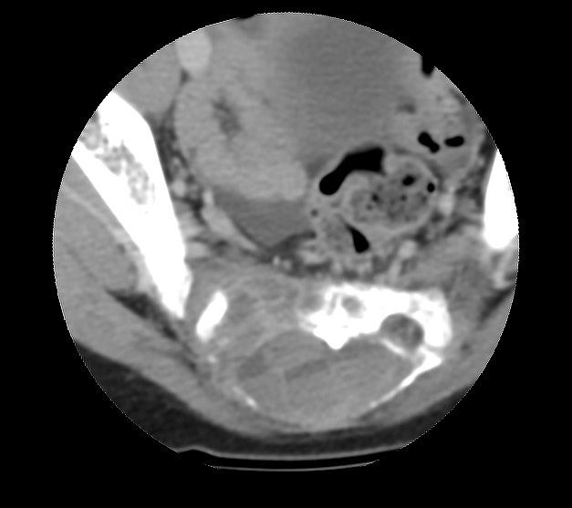 Aneurysmal bone cyst - sacrum (Radiopaedia 65190-74195 Axial non-contrast 31).jpg