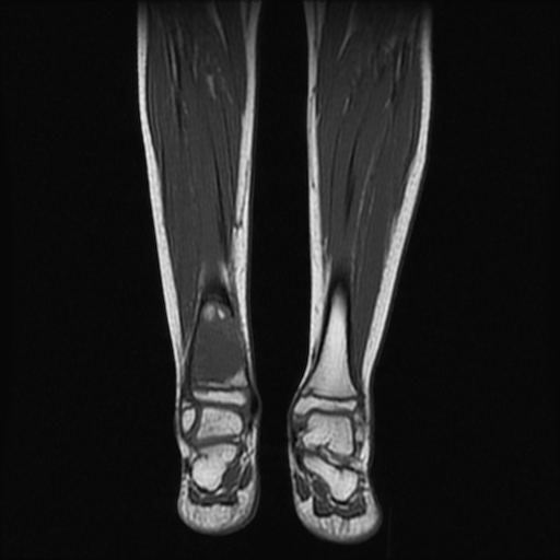 File:Aneurysmal bone cyst - tibia (Radiopaedia 22343-22367 Coronal T1 10).jpg