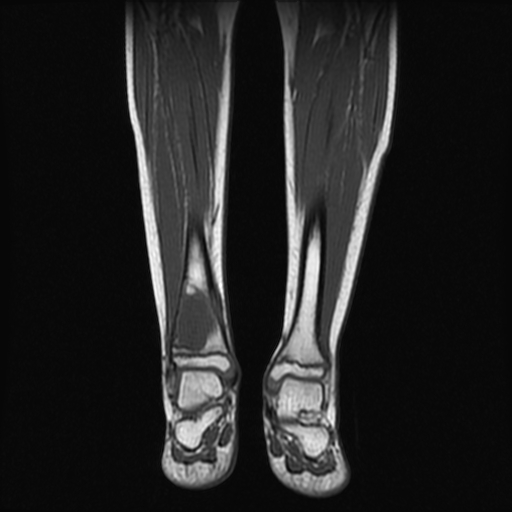 File:Aneurysmal bone cyst - tibia (Radiopaedia 22343-22367 Coronal T1 9).jpg