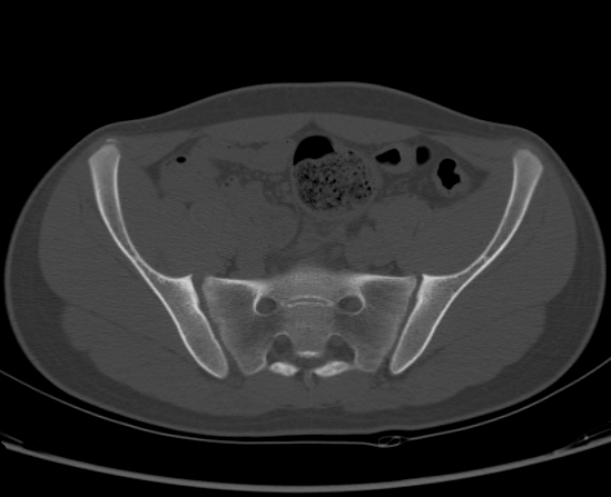 File:Aneurysmal bone cyst of ischium (Radiopaedia 25957-26094 Axial bone window 26).png