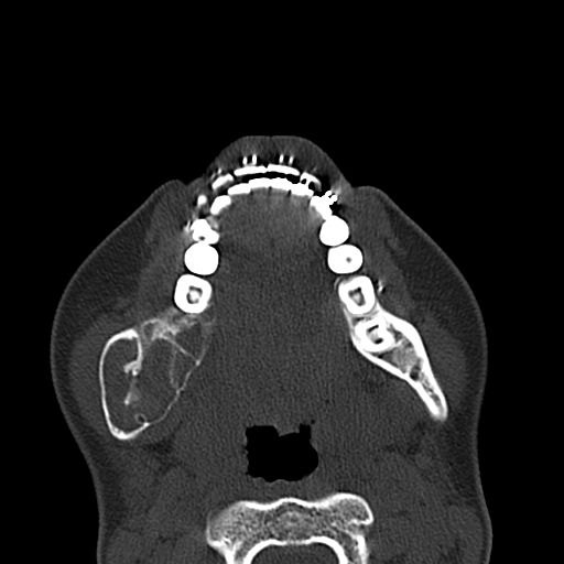 Aneurysmal bone cyst of the mandible (Radiopaedia 43280-46601 Axial bone window 29).jpg