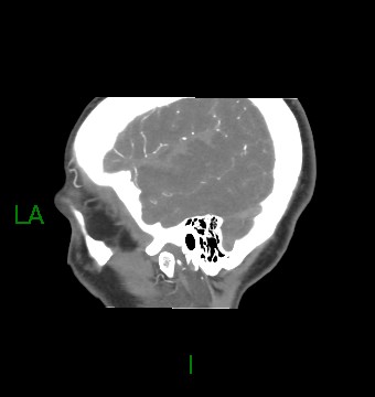 Aneurysmal subarachnoid hemorrhage with intra-axial extension (Radiopaedia 84371-99732 B 60).jpg