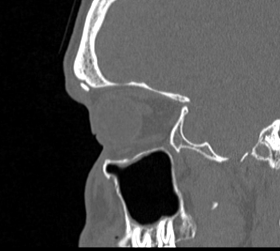 Angular epidermoid cyst (Radiopaedia 46908-51439 Sagittal bone window 17).png