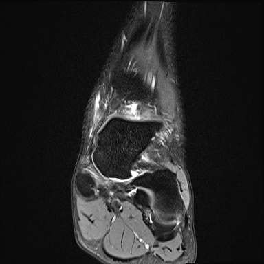 Ankle syndesmotic injury (Radiopaedia 69066-78837 Coronal PD fat sat 39).jpg