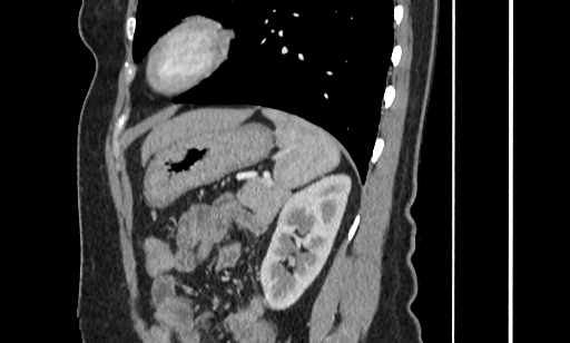 Annular pancreas (Radiopaedia 70359-80453 B 47).jpg