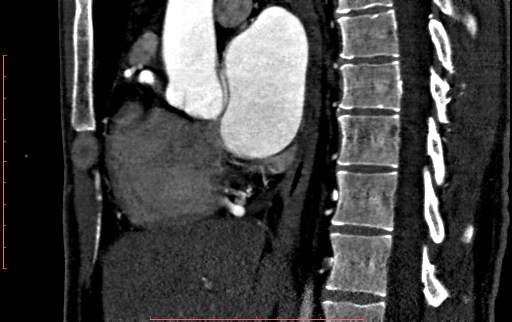 Anomalous left coronary artery from the pulmonary artery (ALCAPA) (Radiopaedia 70148-80181 C 101).jpg