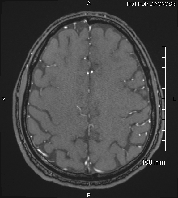 Anterior cerebral artery aneurysm (Radiopaedia 80683-94127 Axial MRA 190).jpg