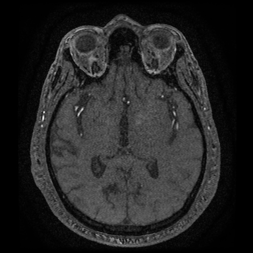Anterior cerebral artery infarction (Radiopaedia 46794-51323 Axial MRA 101).jpg