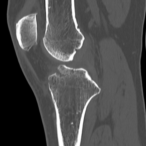 File:Anterior cruciate ligament avulsion fracture (Radiopaedia 58939-66194 Sagittal bone window 22).jpg