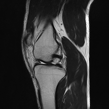 File:Anterior cruciate ligament full thickness tear (Radiopaedia 66268-75467 Sagittal T2 10).jpg