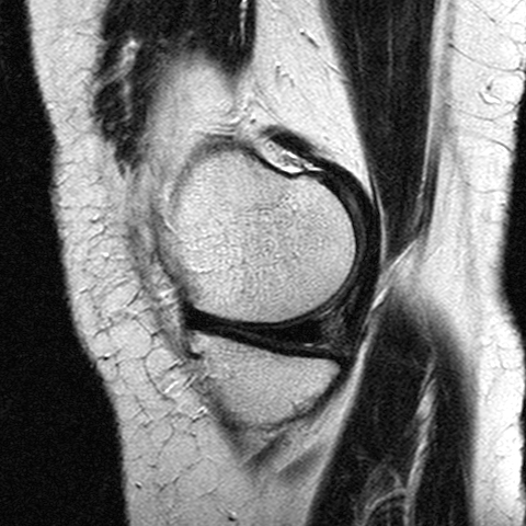 File:Anterior cruciate ligament mucoid degeneration (Radiopaedia 60853-68633 Sagittal T2 9).jpg