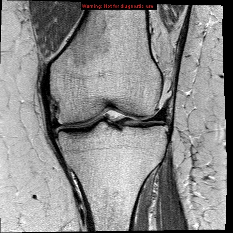 File:Anterior cruciate ligament tear (Radiopaedia 12329-12612 Coronal PD 10).jpg