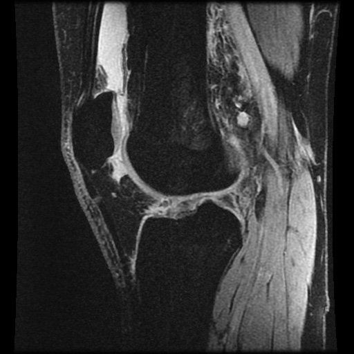 Anterior cruciate ligament tear (Radiopaedia 61500-69462 F 51).jpg