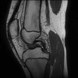 File:Anterior cruciate ligament tear - pediatric (Radiopaedia 62152-70260 Sagittal PD 83).jpg