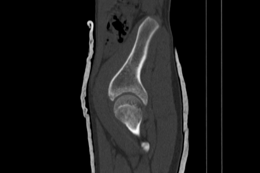 Anterior inferior iliac spine avulsion injury (Radiopaedia 88666-105376 Sagittal bone window 26).jpg