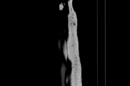 Anterior inferior iliac spine avulsion injury (Radiopaedia 88666-105376 Sagittal bone window 4).jpg