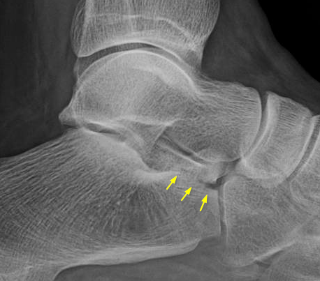 File:Anterior process calcaneus fracture (Radiopaedia 61593-69570 Zoomed lateral view 1).png