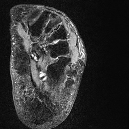 File:Anterior talofibular ligament injury - rupture with soft-tissue impingement (Radiopaedia 38765-40928 D 32).jpg