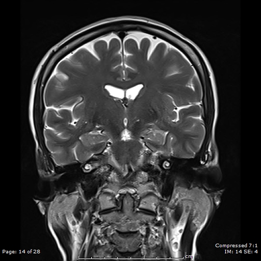 File:Anterior temporal lobe perivascular space (Radiopaedia 88283-104914 Coronal T2 14).jpg