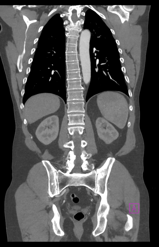 Aortectomy and axillary-bifemoral bypass (Radiopaedia 28303-28545 C 65).jpg