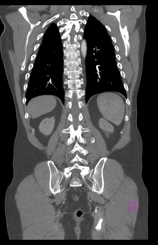 Aortectomy and axillary-bifemoral bypass (Radiopaedia 28303-28545 C 70).jpg