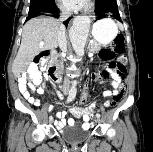 Aortic aneurysm and Lemmel syndrome (Radiopaedia 86499-102554 C 28).jpg