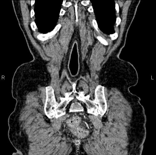 Aortic aneurysm and Lemmel syndrome (Radiopaedia 86499-102554 C 60).jpg