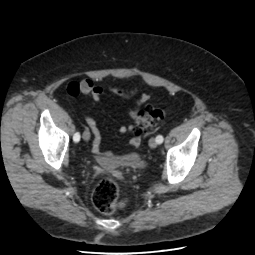 File:Aortic aneurysm and dissection - Stanford type A (Radiopaedia 36693-38261 A 91).png