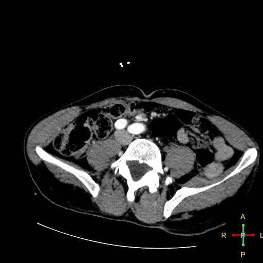 File:Aortic aneurysm and penetrating ulcer (Radiopaedia 23590-23704 A 38).jpg