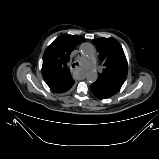 Aortic arch aneurysm (Radiopaedia 84109-99365 Axial non-contrast 108).jpg