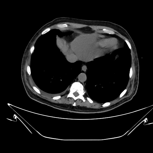 Aortic arch aneurysm (Radiopaedia 84109-99365 Axial non-contrast 223).jpg