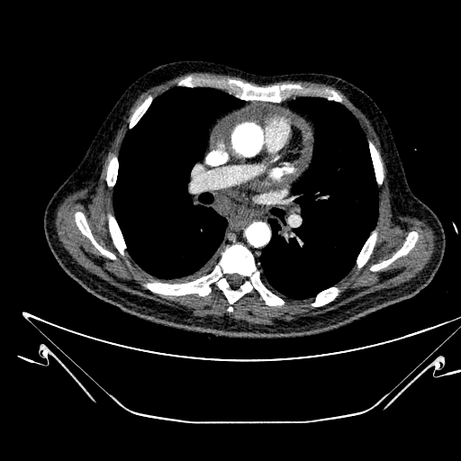 Aortic arch aneurysm (Radiopaedia 84109-99365 B 308).jpg