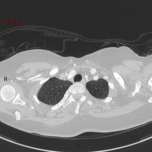 Aortic arch origin of left vertebral artery (Radiopaedia 51520-57286 Axial lung window 34).jpg