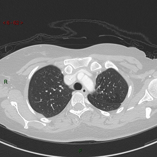 Aortic arch origin of left vertebral artery (Radiopaedia 51520-57286 Axial lung window 62).jpg
