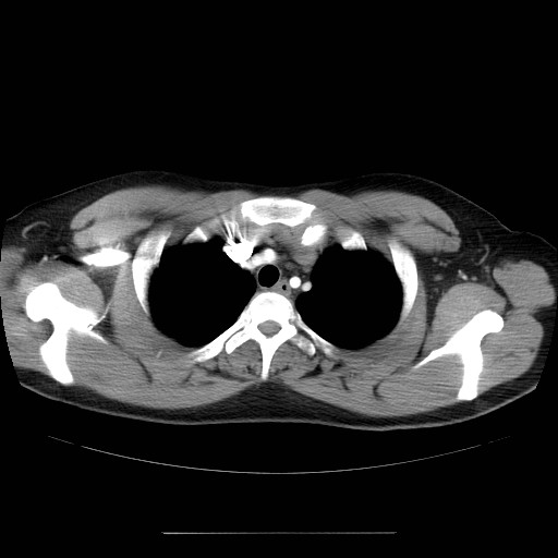 File:Aortic arch stent (Radiopaedia 30030-30595 D 5).jpg