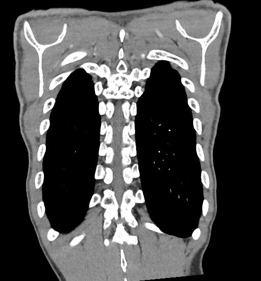 Aortic coarctation with aneurysm (Radiopaedia 74818-85828 C 100).jpg