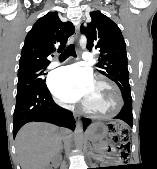 Aortic coarctation with aneurysm (Radiopaedia 74818-85828 C 64).jpg