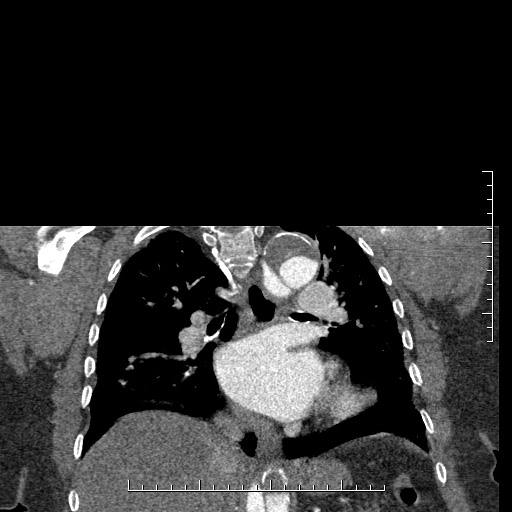 File:Aortic dissection- Stanford A (Radiopaedia 35729-37268 E 19).jpg