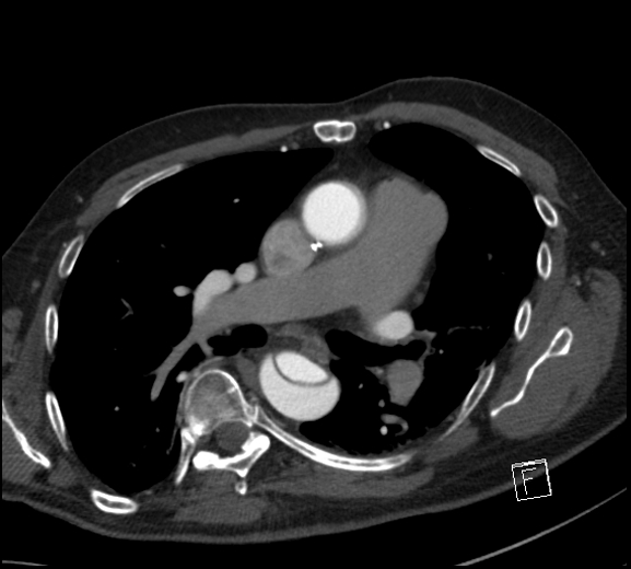 Aortic dissection (CTPA) (Radiopaedia 75506-86750 A 45).jpg