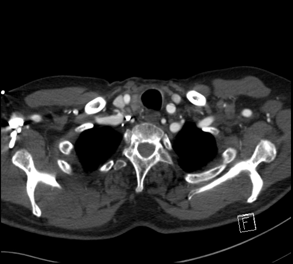 File:Aortic dissection (CTPA) (Radiopaedia 75506-86750 A 8).jpg