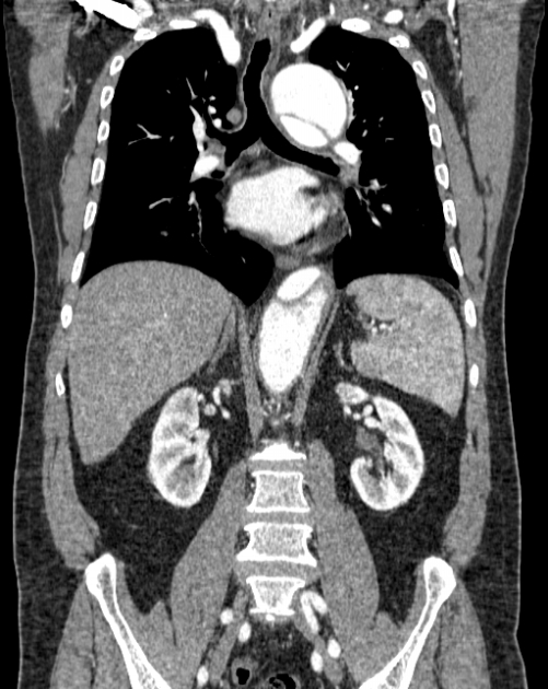Aortic dissection (Radiopaedia 44411-48061 A 33).jpg